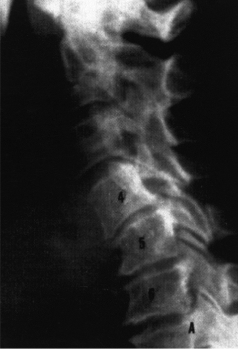 At Last Chiropractic spinal degeneration phase 3