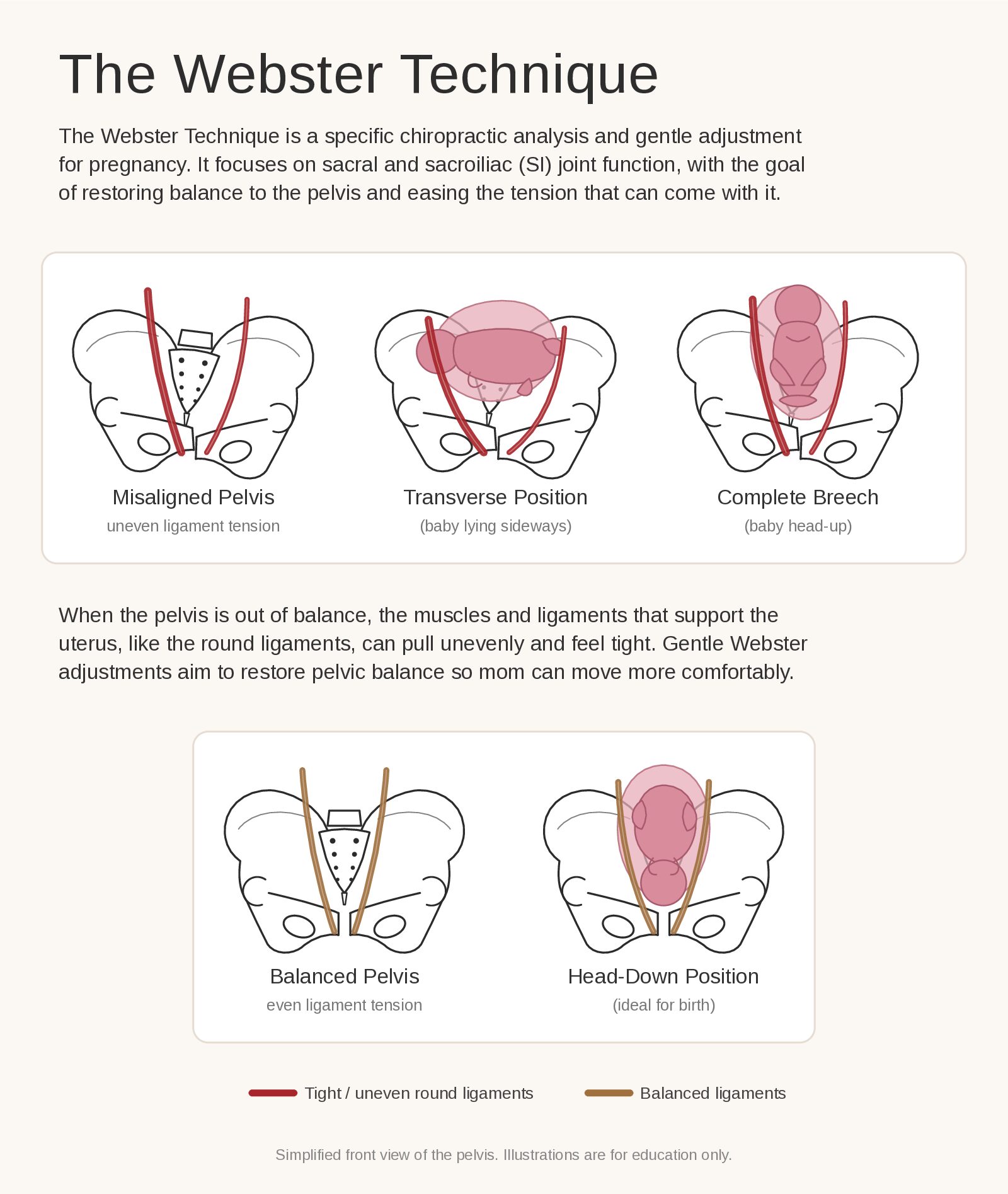 Webster Technique infographic illustrating pelvic alignment during pregnancy